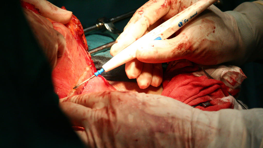 Understanding the Difference Between Electrosurgery and Electrocautery